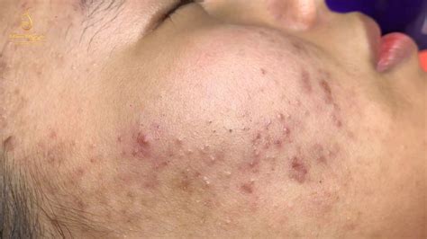My thought exactly. . Loan nguyen cystic acne